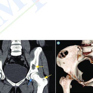 -Hip x-ray (yellow arrows -lytic bone lesions on iliac bone) | Download ...