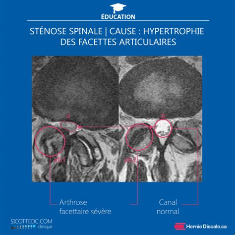 Sténose spinale lombaire Symptômes Traitement non chirurgicale