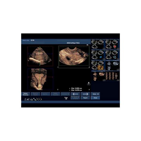 Combination Iup Ectopic Pregnancy Transvaginal Ultrasound Training