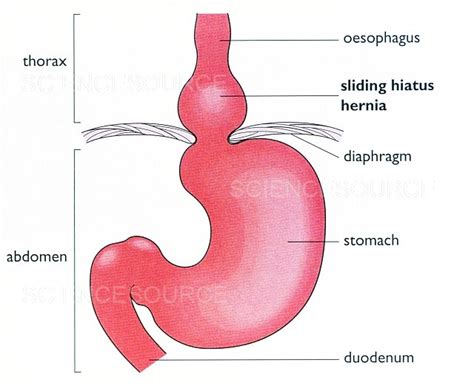 Sliding hiatus hernia | Stock Image - Science Source Images