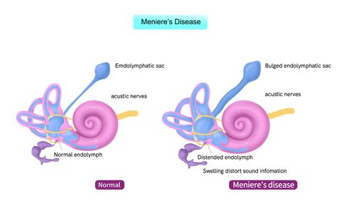 Ear MÉniÈre’s Disease Dr Meenesh Juvekar Ent Specialist