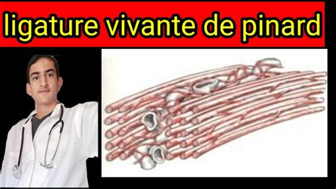 Ligature Vivante De Pinard YouTube