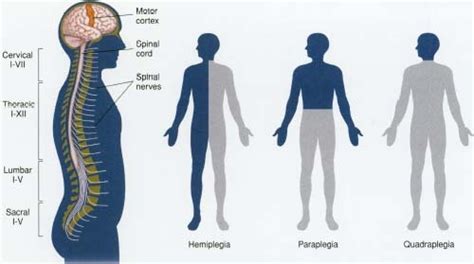 Paralysis Body Causes What Is Paralysis