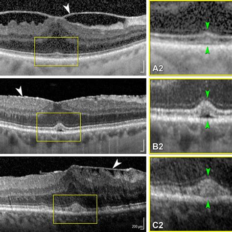 Sample cases from group II. Case 1: (a) baseline OCT scan of DME with ...