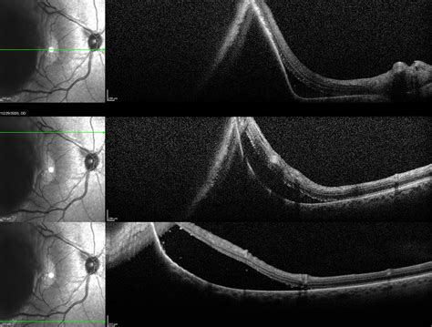 Choroidal Melanoma Fluorescein Angiography