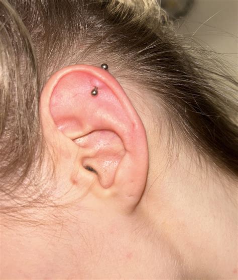 If I Take Out My Helix Piercing Will The Irritation Bump Stay Forever