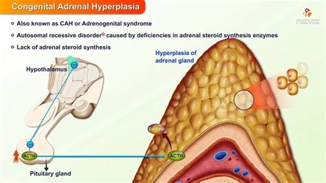 Congenital Adrenal Hyperplasia Etiology Pathophysiology Clinical