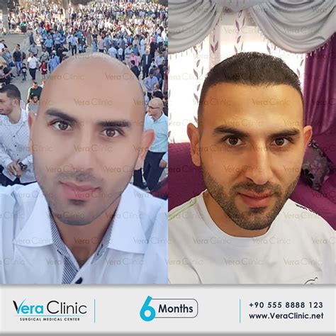 Vera Clinic Hair Transplant Doctors Combine Their Long Experience With