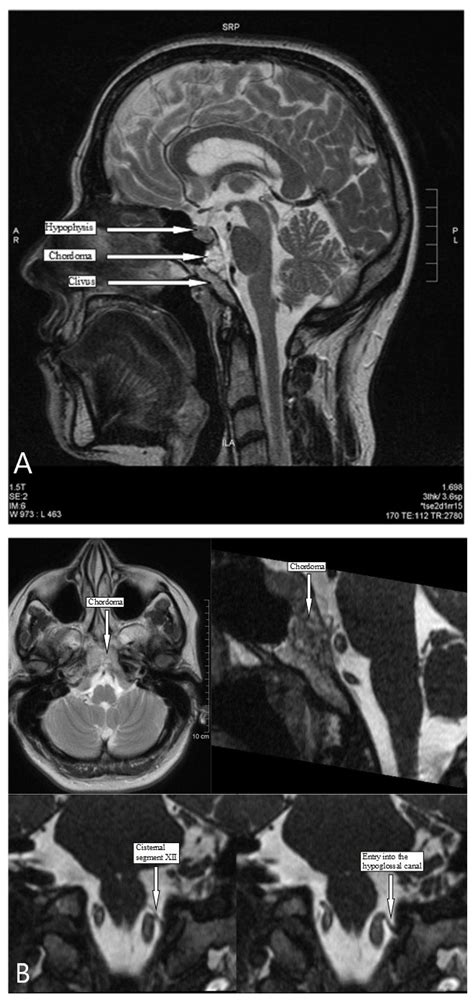 IJERPH Free Full Text Isolated Hypoglossal Nerve Palsy As An Early