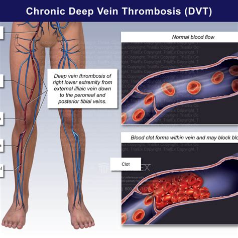 Chronic Deep Vein Thrombosis Dvt Trialexhibits Inc