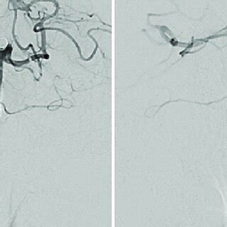 Anteroposterior Views Of The Right A And Left B Vertebral Artery