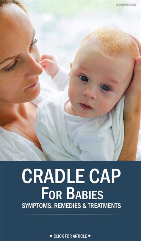 Cradle Cap What It Is Causes Symptoms And Traeatment Cradle Cap