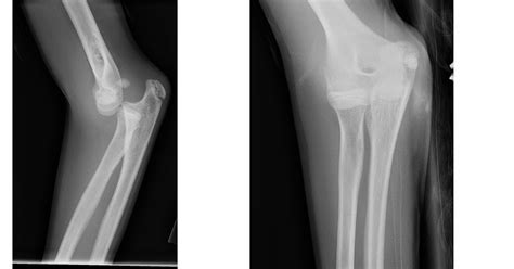 Shoulder and Elbow Surgery: Pediatric medial epicondyle elbow fractures