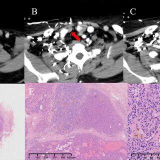 The 99mTc-MIBI SPECT/CT scan shows focused tracer accumulation with a ...