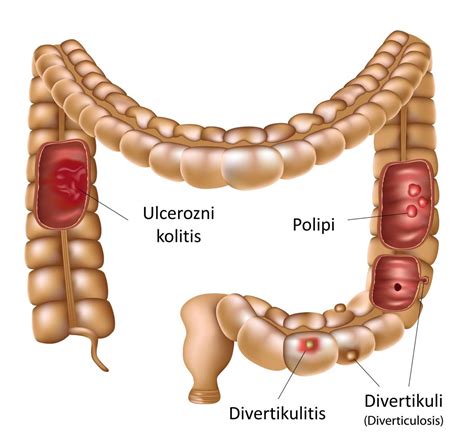 Rizici Za Razvoj Raka Debelog Crijeva Zzjzdnz Hr