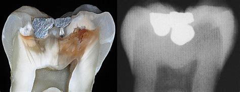 Diagnosis Dental Caries Dentine Caries