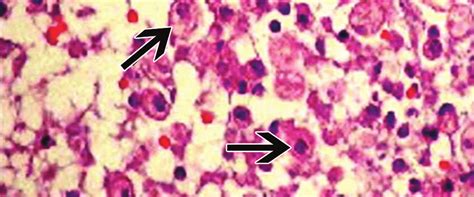 Amebic Trophozoites As Shown With Arrows Note The Neutrophilic And