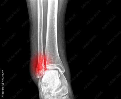 x-ray of ankle fracture Stock Photo | Adobe Stock