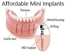 Mini Implants | Mountainside Oral Care