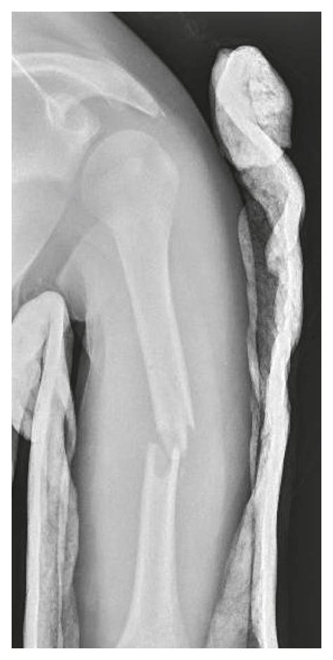 Anteroposterior Radiograph Following Reduction And Coaptation Splinting Download Scientific