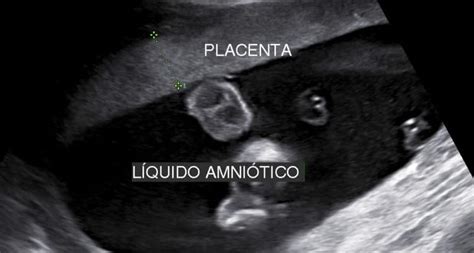 Biometria Fetalmed Medicina Fetal Em Curitiba