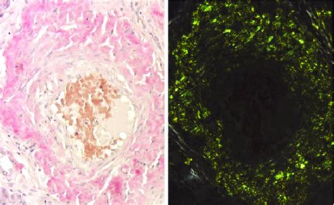 Congo Red Staining And Darkfield Microscopy Demonstrating Amyloid