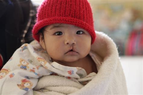 Why We Should No Longer Call Cleft Lip A Harelip” Deutsche Cleft