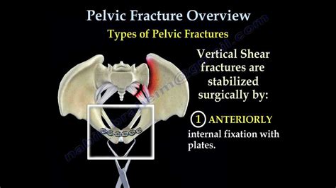 Which Is Worse Broken Hip Or Pelvis The New Answer