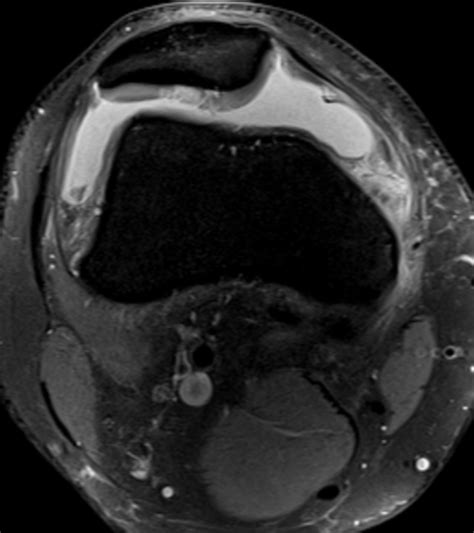 Transient Patellofemoral Dislocation Wiberg Iii Patella