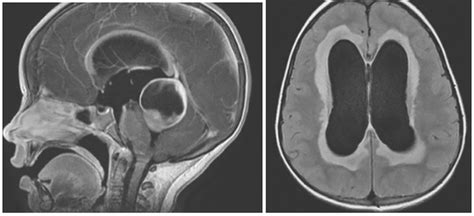 Гидроцефалия головного мозга на МРТ виды признаки заключение МРТ при