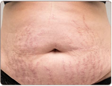 Kolors Hair And Skin Stretch Marks Removal Images