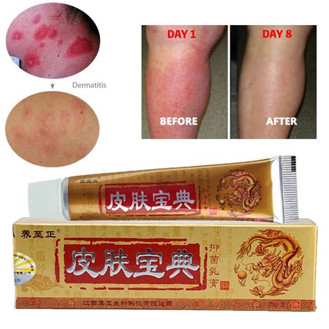 Natural Chinese Herbal Anti Bacteria Psoriasis Cream Eczema Ointment