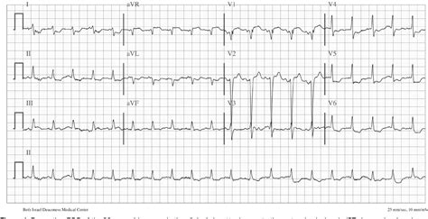 Figure 1 from Subclavian Steal Syndrome C U PDATE | Semantic Scholar