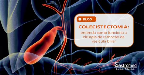 Colecistectomia entenda como funciona a cirurgia de remoção da