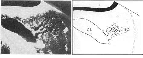 Figure 2 from Progress report Ultrasound and gastroenterology | Semantic Scholar