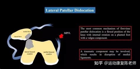 【锐博康复科普】被“妖魔化”的髌骨脱位，教你如何康复解决它 知乎