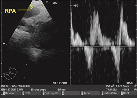 Techniques Of Linear Endobronchial Ultrasound Intechopen