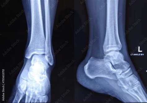 X-ray or radiograph of an ankle showing anatomy of bones and joint of ...