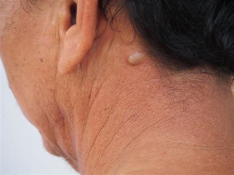 Epidermoid Cysts Neck