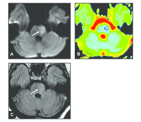 Brain Mri Axial Dwi A Adc Map B Axial Flair C Showing Left