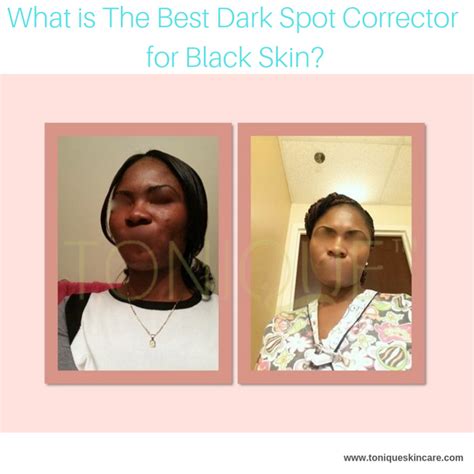 What is The Best Dark Spot Corrector for Black Skin? - Tonique Skincare