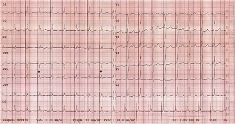 His Bundle Pacing In A Patient In Atrial Fibrillation With Normal