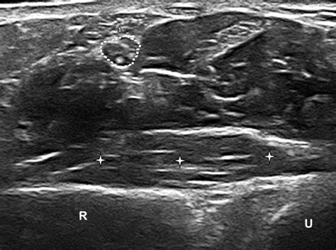 Bifid Median Nerve In Carpal Tunnel Syndrome Assessment With US Cross