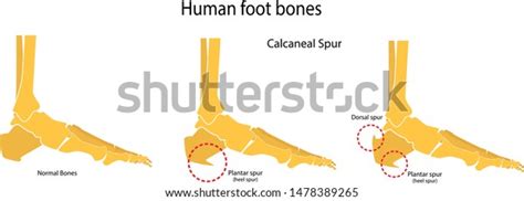 Human Foot Bones Plantar Dorsal Spur Stock Vector Royalty Free 1478389265