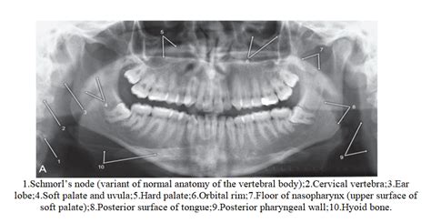 Anatomical Landmarks On Panoramic X Ray