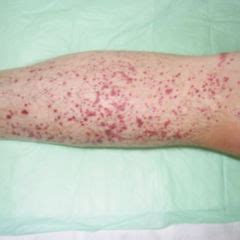 Periorbital Petechiae