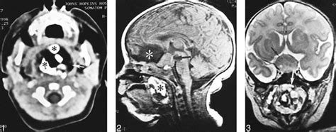 A Heterotopic Cerebellum Presenting As A Suprasellar Mass With