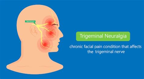 Medifocus Guidebook On Trigeminal Neuralgia