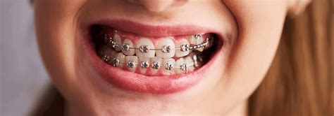 Gingivitis And Braces Signs Causes And Prevention