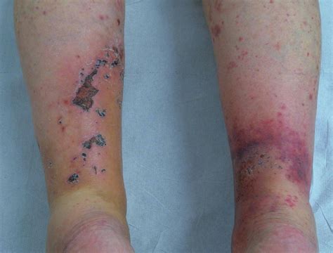 —allopurinol Induced Cutaneous Vasculitis Presenting As Purpuric And Download Scientific